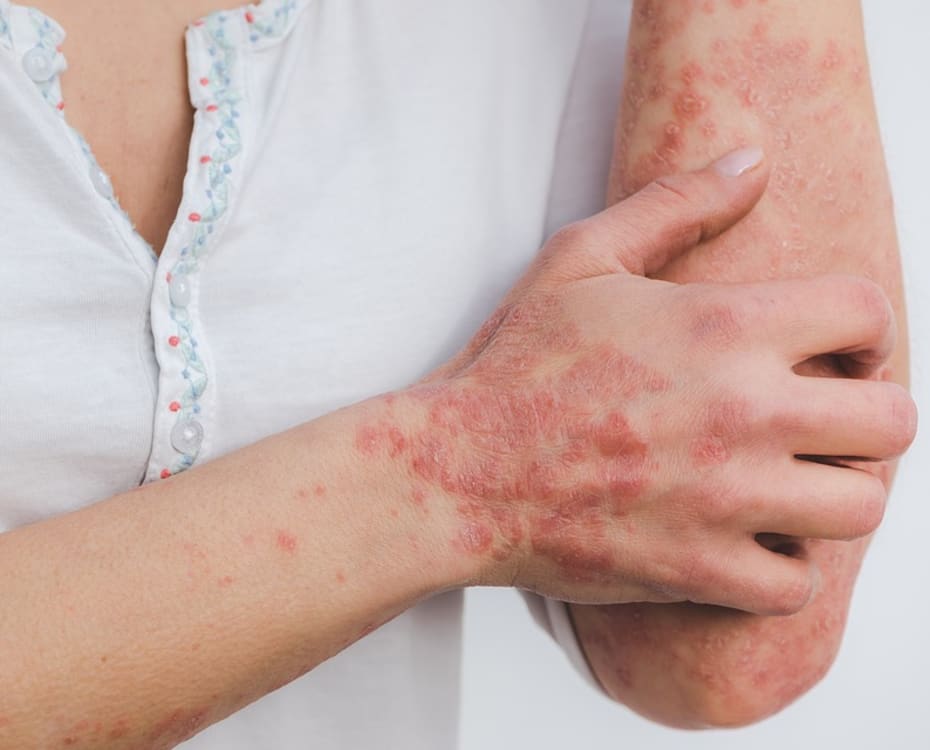 huidziekten-psoriasis