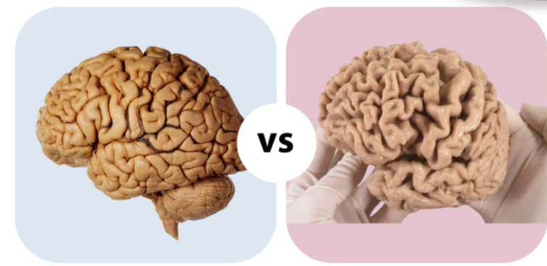 Het plaatje toont een vergelijking tussen hersens van een gezond persoon en hersenen van een persoon met vergevorderde dementie.