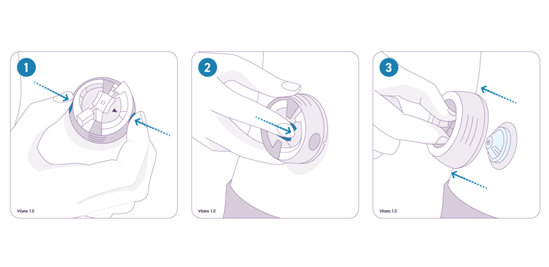 Voorbeeld van een beeldinstructie voor het openen van een injectiepoort